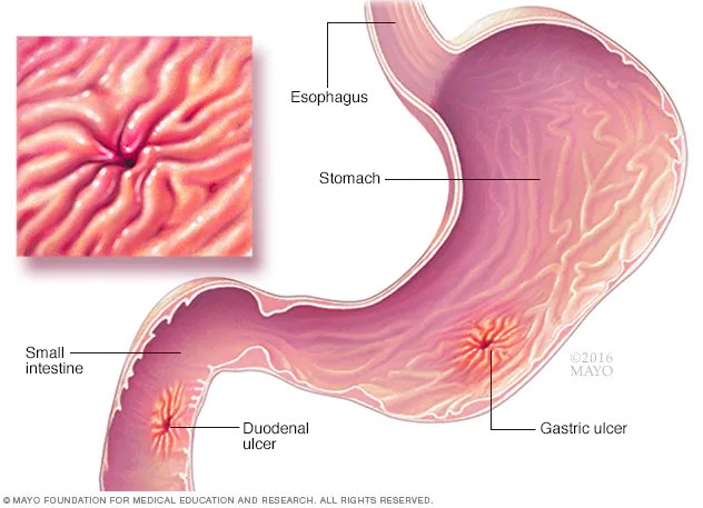 ulcerat-gastrike-dhe-4-komplikacionet-me-te-shpeshta-qe-shkaktohen