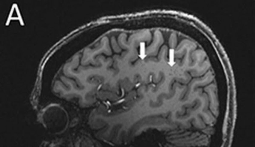 ​ndryshime-misterioze-te-trurit-zbulohen-te-njerezit-me-migrene