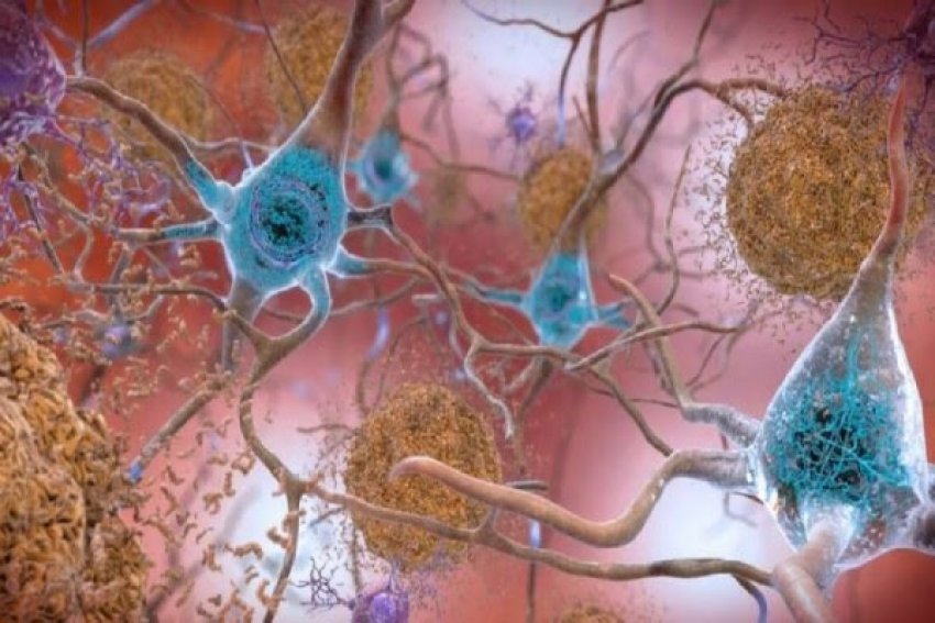 ​studimi-i-ri-tregon-lidhjen-midis-sasise-se-proteinave-amiloide-me-semundjen-e-alzheimerit