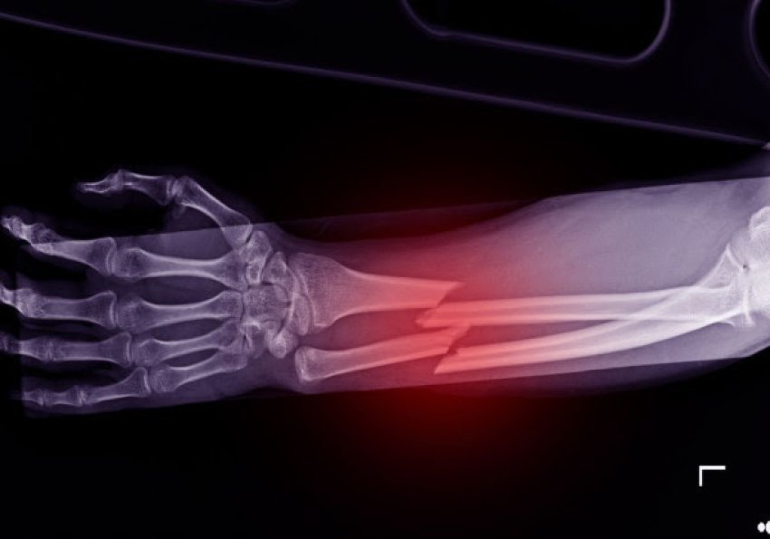 ​shpiket-ngjitesi-i-kockave,-qe-riparon-frakturat-per-tri-minuta