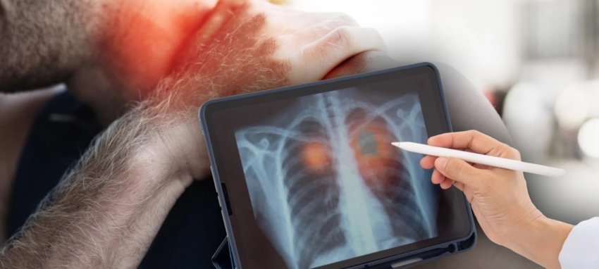 cfare-dhimbje-ne-shpatull-mund-te-tregoje-per-kancerin-e-mushkerive-–-ndonjehere-eshte-shenja-e-pare-e-ketij-karcinomi