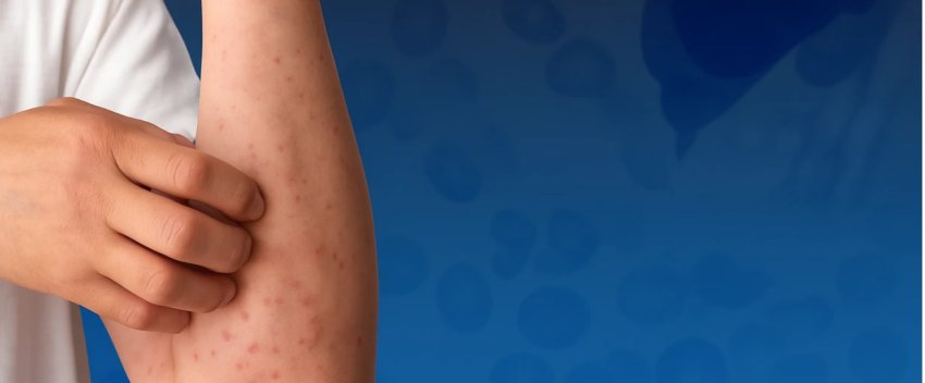 kruarje,-djersitje-dhe-lodhje-–-semundje-e-rralle-e-gjakut-qe-kerkon-trajtim-te-hershem-dhe-terapi-inovative