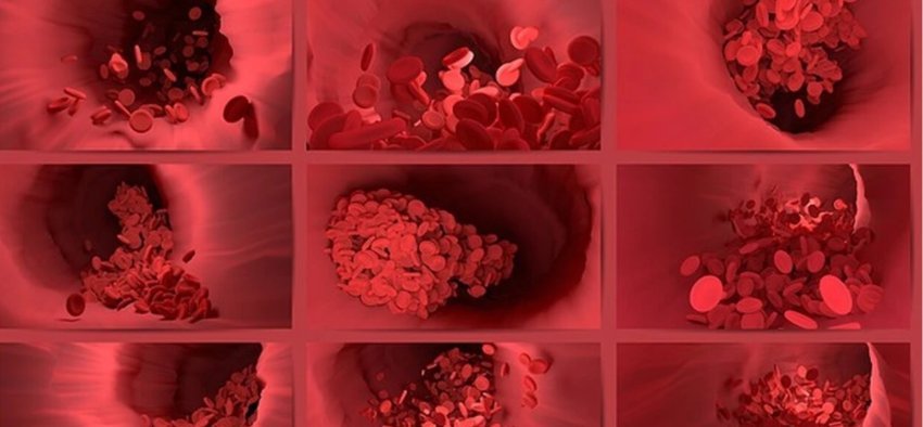 a-mund-ta-ndiejme-trombin-para-se-te-behet-i-rrezikshem?