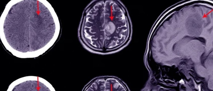 nje-nderhyrje-e-thjeshte-qe-ul-ndjeshem-rrezikun-e-gjakderdhjes-ne-tru-pas-operacionit