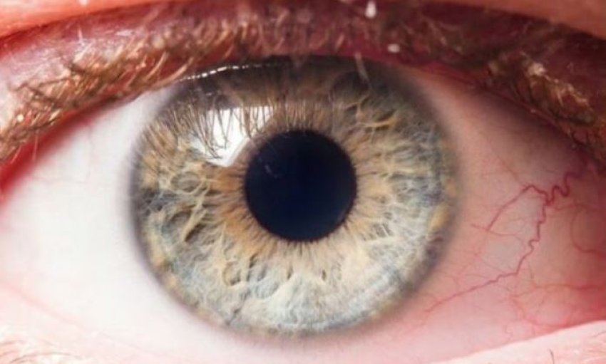 epidemia-e-heshtur-e-verberise:-rastet-e-glaukomes-po-rriten,-ndersa-miliona-mbeten-te-padiagnostikuar