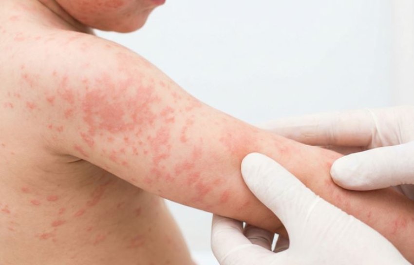 fruthi-perhapet-ne-londer,-60-femije-te-infektuar