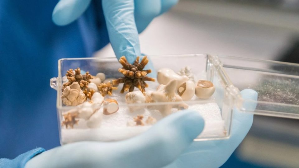 kafeja-dhe-pijet-e-gazuara-ne-vend-te-ujit-mund-te-nxisin-guret-ne-veshka:-si-ndikon-edhe-stresi-te-pacientet