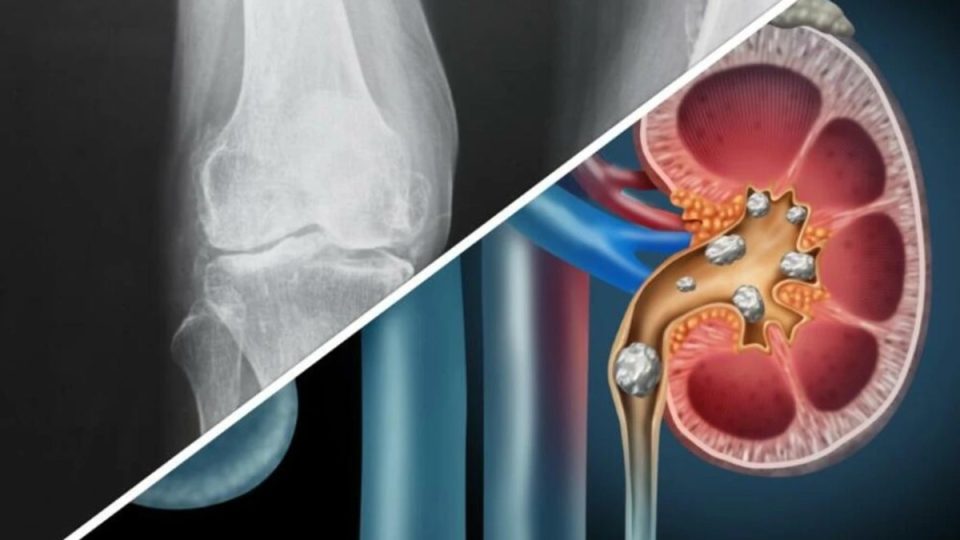 pse-krijohen-kalcifikimet-dhe-ne-cilat-pjese-te-trupit-shfaqen-me-shpesh