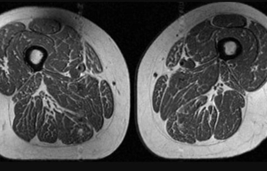 ushqimet-e-ultraperpunuara-po-ndryshojne-strukturen-e-muskujve-te-trupit