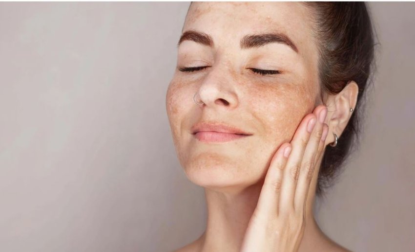 njollat-e-erreta-ne-fytyre-nuk-zhduken-vete:-si-t’i-zbusni-hiperpigmentimet-dhe-ta-barazoni-tenin