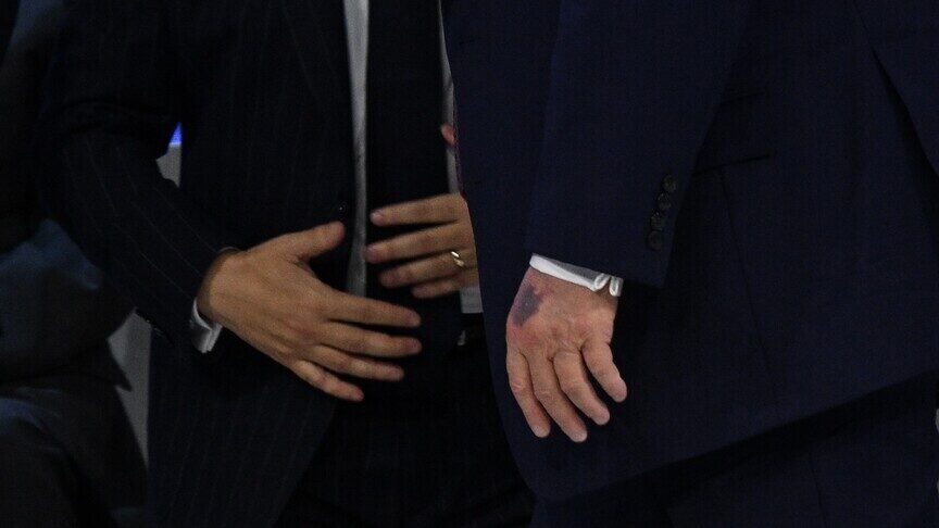 mjeku-i-trumpit-pretendon-se-mavijosjet-ne-duart-e-presidentit-jane-shkaktuar-nga-“shtrengimet-e-shpeshta-te-duarve”