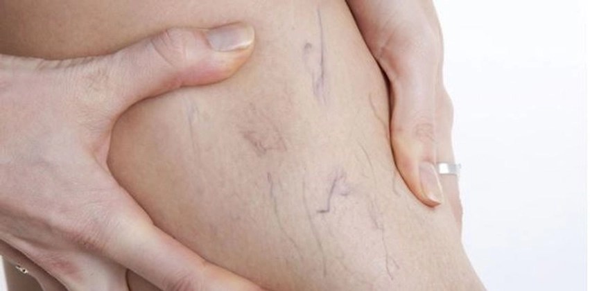 5-mite-dhe-te-verteta-rreth-semundjeve-venoze