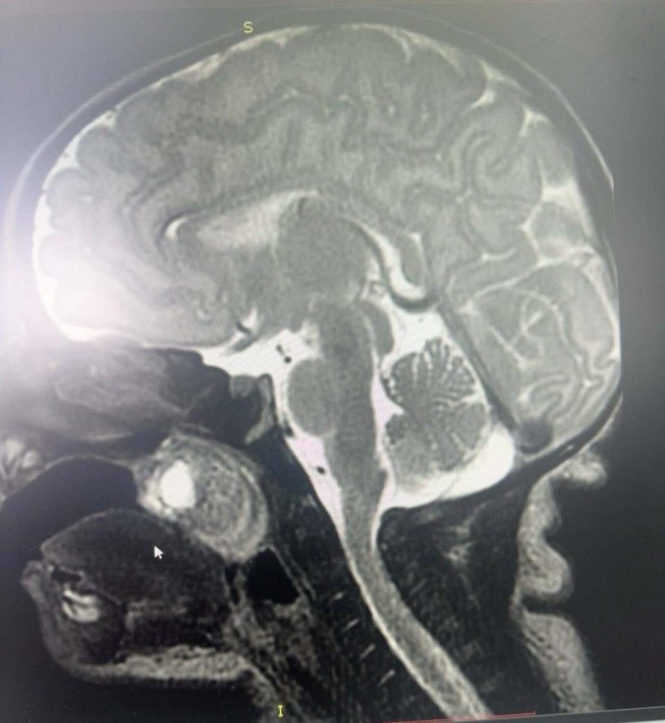 realizohet-ne-qkuk-nje-nderhyrje-e-rralle-kirurgjikale,-te-nje-foshnje-njejaveshe-me-tumor-kongjenital-qe-i-rrezikonte-jeten
