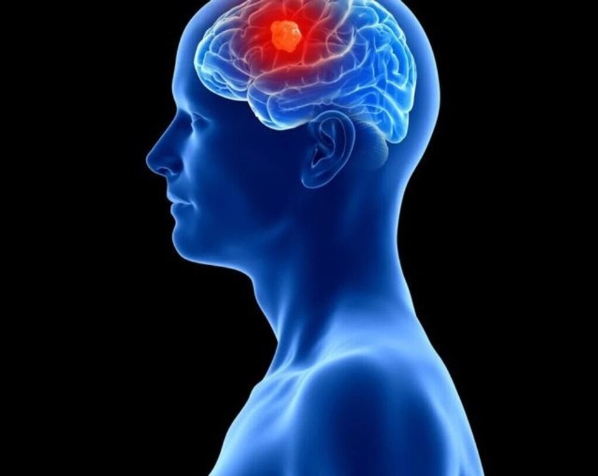 implant-i-ri-cerebral-per-zbulimin-dhe-luftimin-e-kancerit-te-trurit