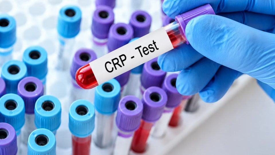 proteina-c-reaktive:-a-duhet-ta-bejne-edhe-te-shendetshmit-kete-analize-te-gjakut?