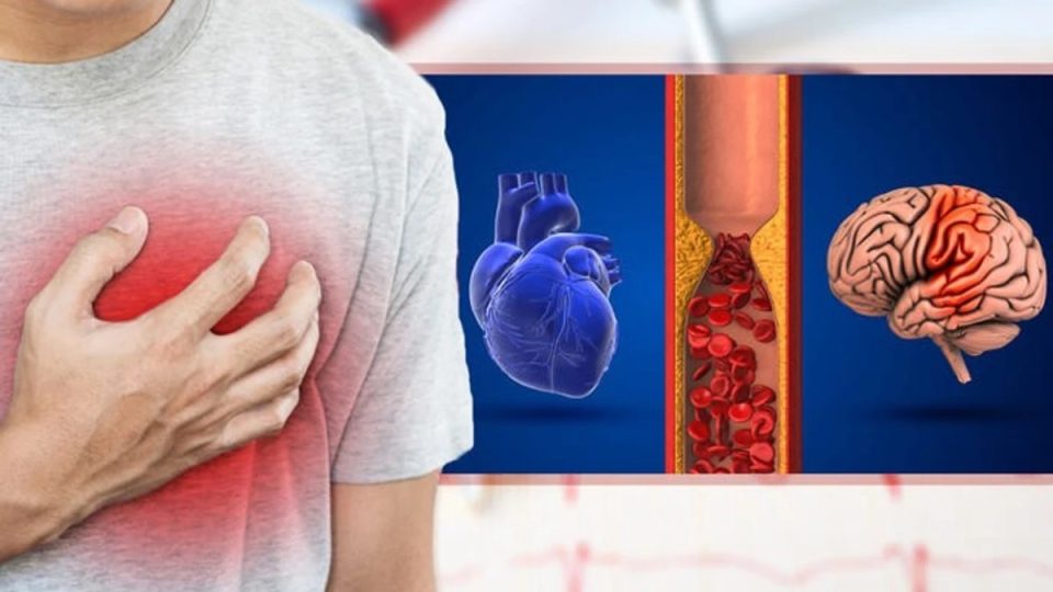 fibrilacioni-atrial-dhe-goditja-ne-tru:-sa-mund-te-ndihmoje-aktiviteti-fizik