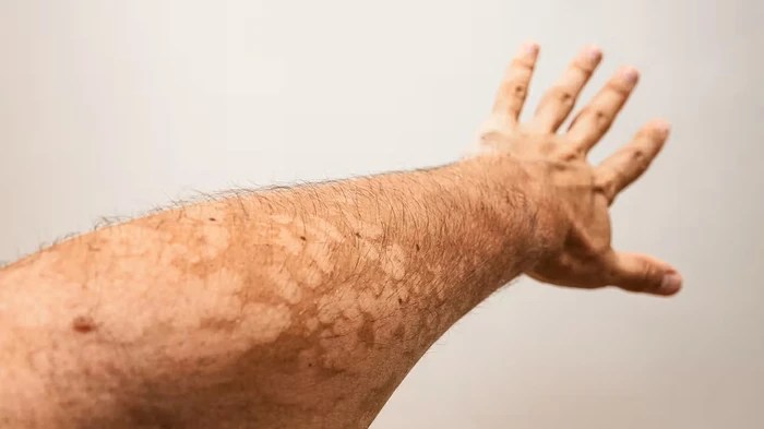 pityriasis-versicolor-ndryshon-ngjyren-e-lekures:-pse-shfaqen-njollat-dhe-si-trajtohen